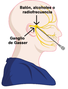 Radiofrecuencia del Ganglio de Gasser - Neurología Segura